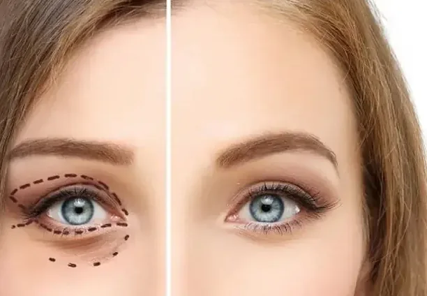 Oculoplasty