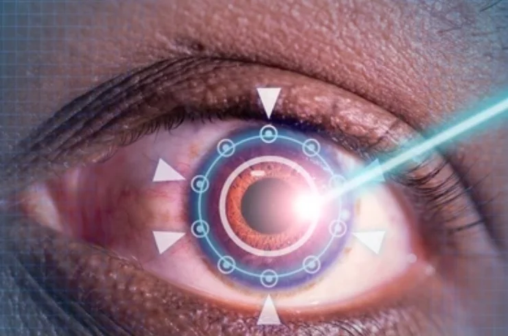 Cornea & LASIK-------15