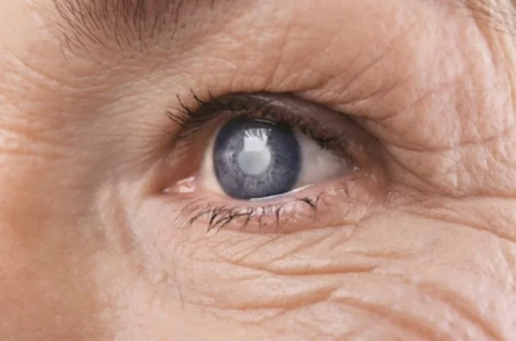 Glaucoma------15