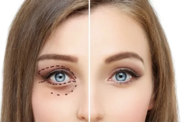 Oculoplasty-----15